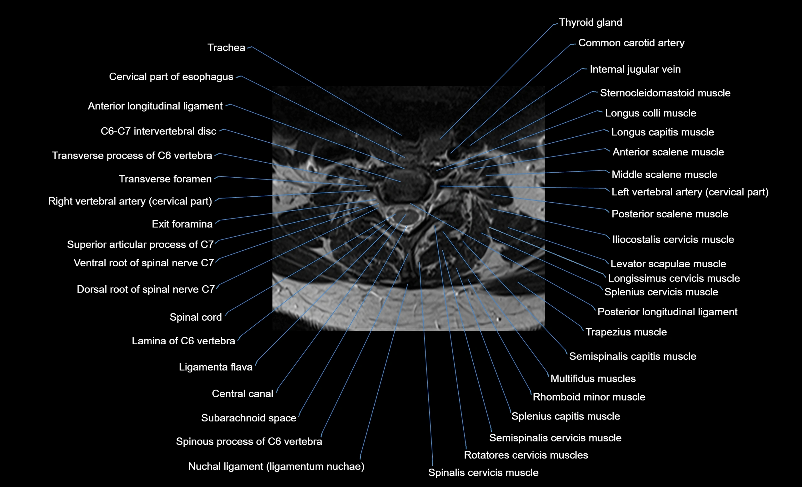 cervical spine cross sectional MRI anatomy  3T MRI axial  image-img-00001-00033.webp